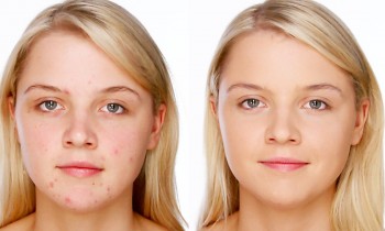 Acne/Blemish Covering Makeup – Foundation & Concealer Tutorial