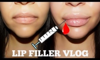 Getting Lip Injections for the first time ! | Honest Vlog !